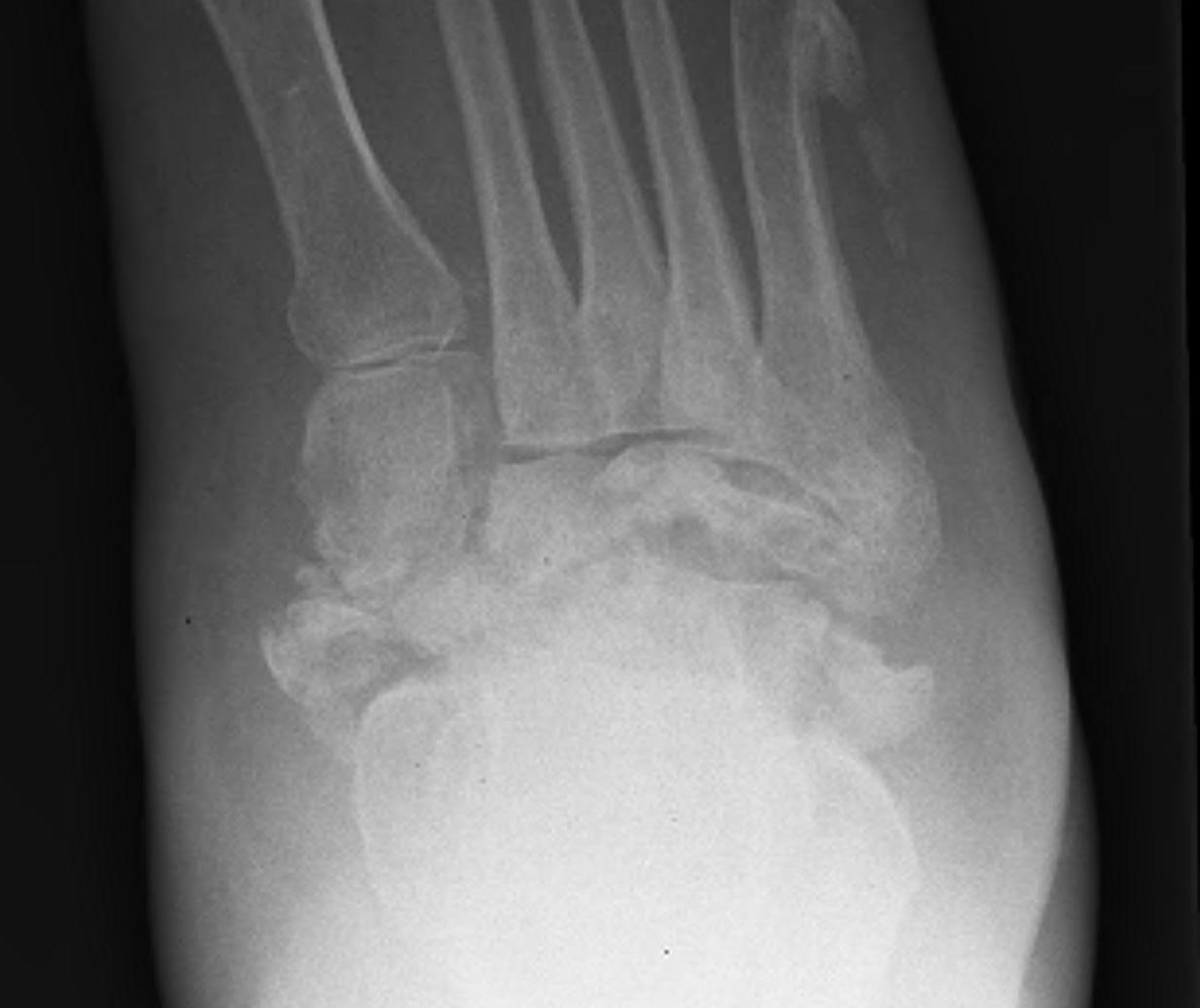 Charcot Foot Stage 2 Resolution